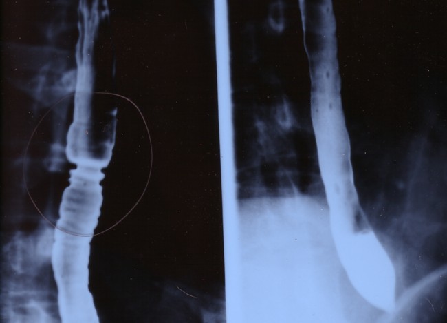 x-ray of man's throat during barium swallow