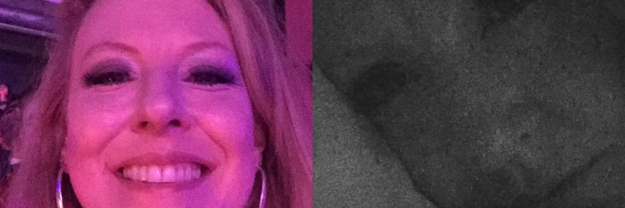 Lyme Disease: Facing Judgment and Scrutiny With Chronic Illness photo of woman out at night and photo of her the next morning in bed