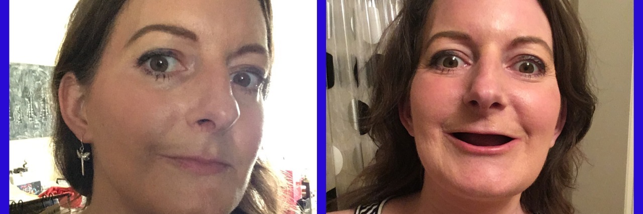 Using Humor to Cope With Having All My Teeth Removed photos of a woman without teeth