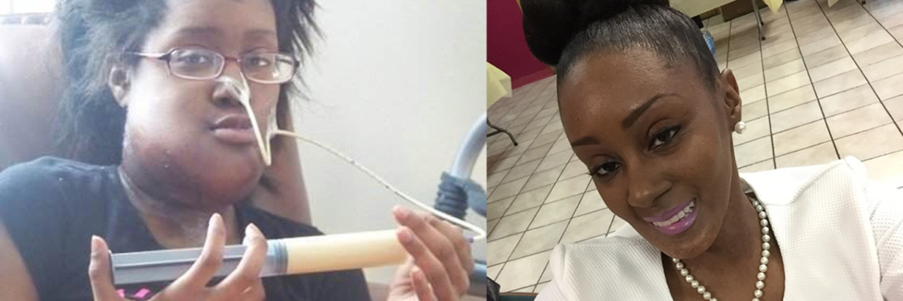 Before and After Photos Reveal Reality of Having Head and Neck Cancer Sarah Anderson Feature
