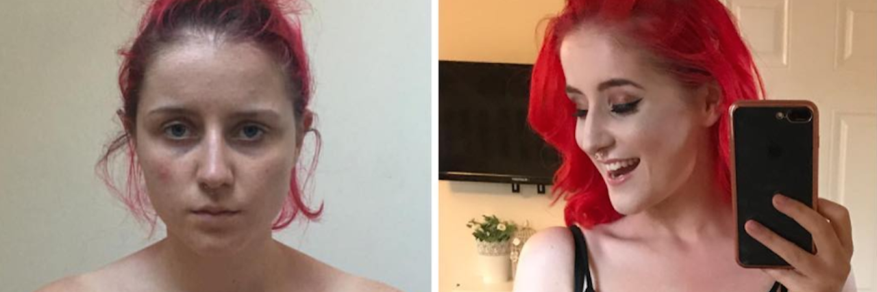 Milly Smith Posts Photos to Prove There's No 'Look' to Being Suicidal two photos of Milly Smith