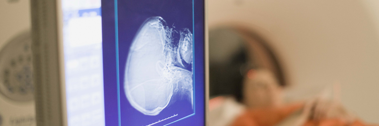 An Open Letter to My Radiation Therapists After Cancer Treatment Patient in MRI machine