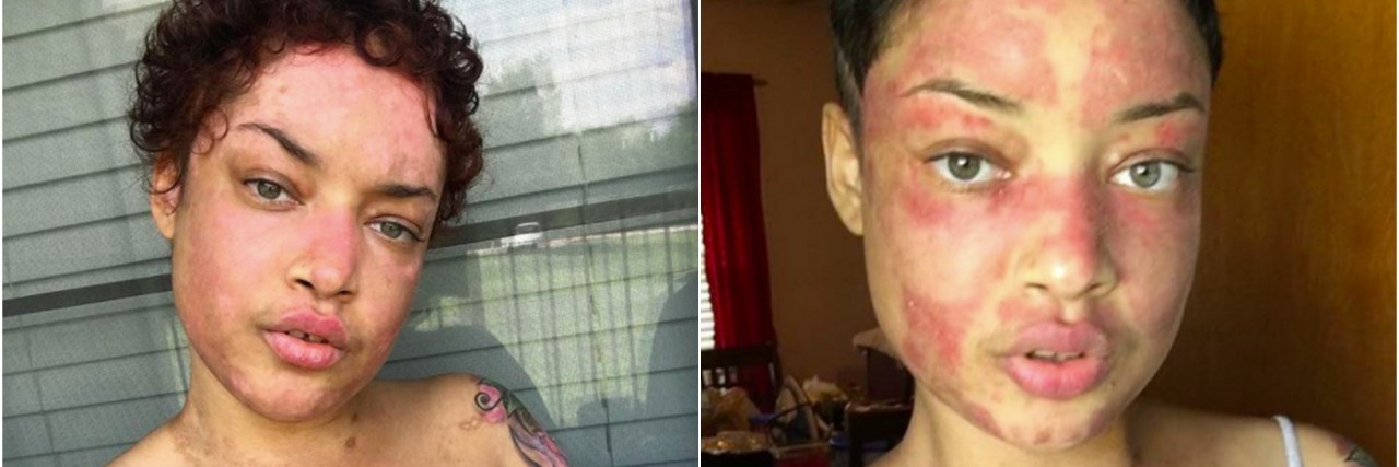 Jokiva Bellard Posts Photos of Skin With Discoid Lupus on Instagram jokiva bellard