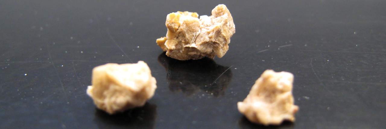 Raising Awareness of Sepsis in Patients With Medullary Sponge Kidney kidney stones