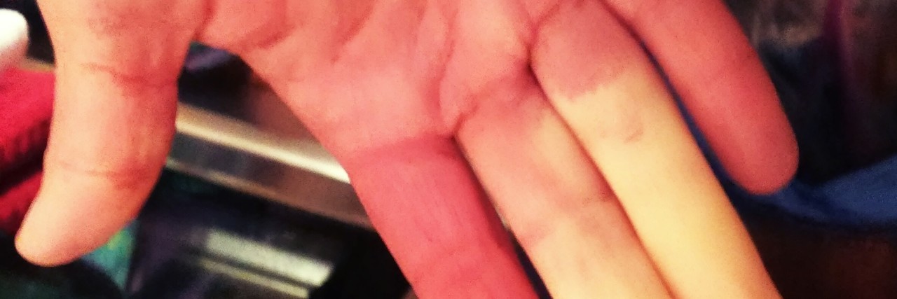 What It's Like to Have Secondary Raynaud's Disease a woman's hand affected by raynauds
