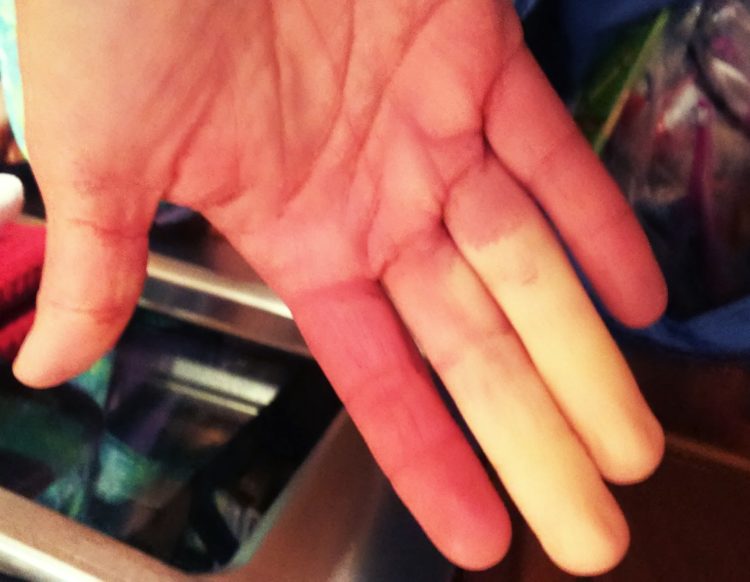 a woman's hand affected by raynauds