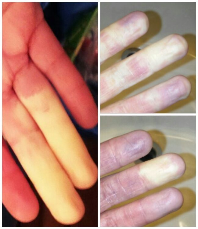 collage of fingers affected by raynauds