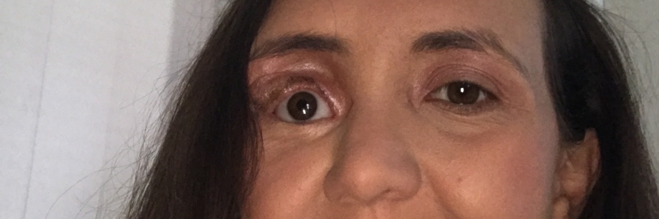 Finding My Beauty With Neurofibromatosis and a Facial Difference photo of the author