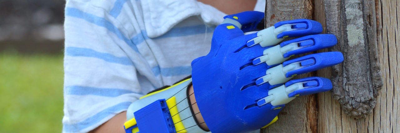 Different Heroes Changes Lives With 3D Printed Hands