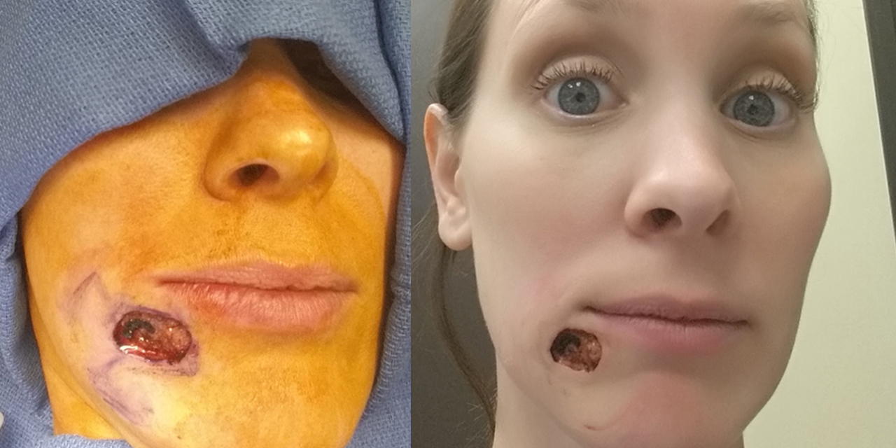 skin cancer on face looks like pimple