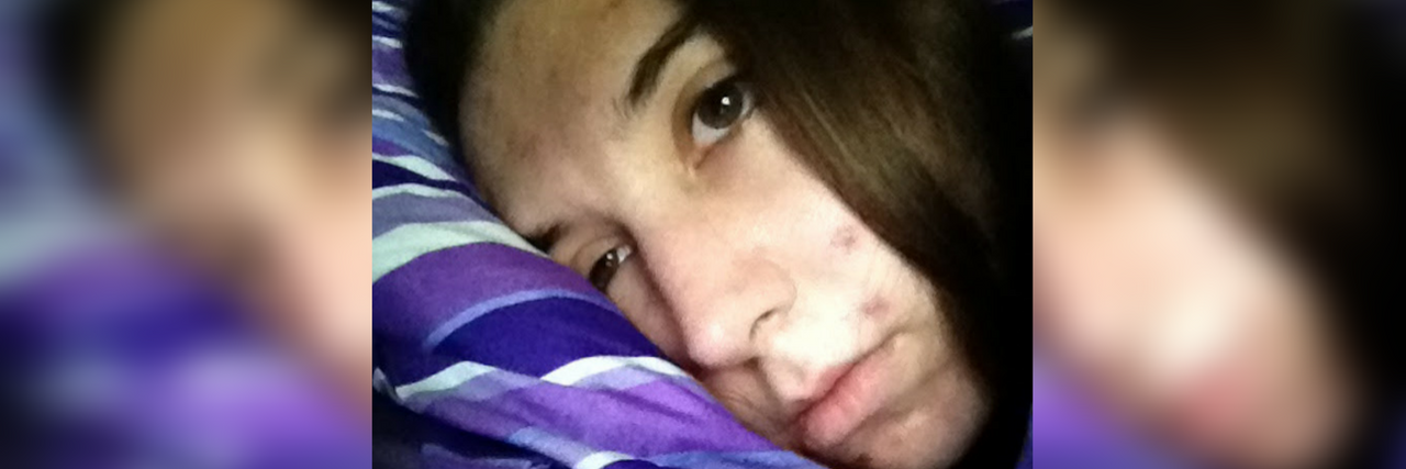 When Migraine Is Treated Like a Zebra Among the Horses woman lying in bed with a migraine