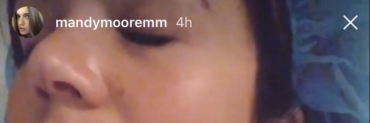 Mandy Moore Shares Her Upper Endoscopy for Celiac Disease on Instagram mandy moore instagram endoscopy
