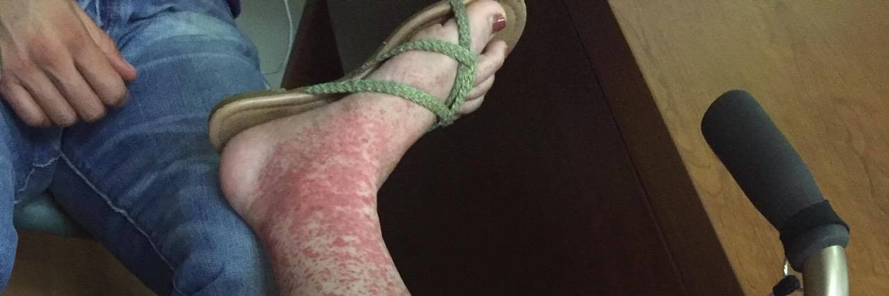 Woman Shares Photo of Her Legs After Tick Bite woman's leg with red rash on calf