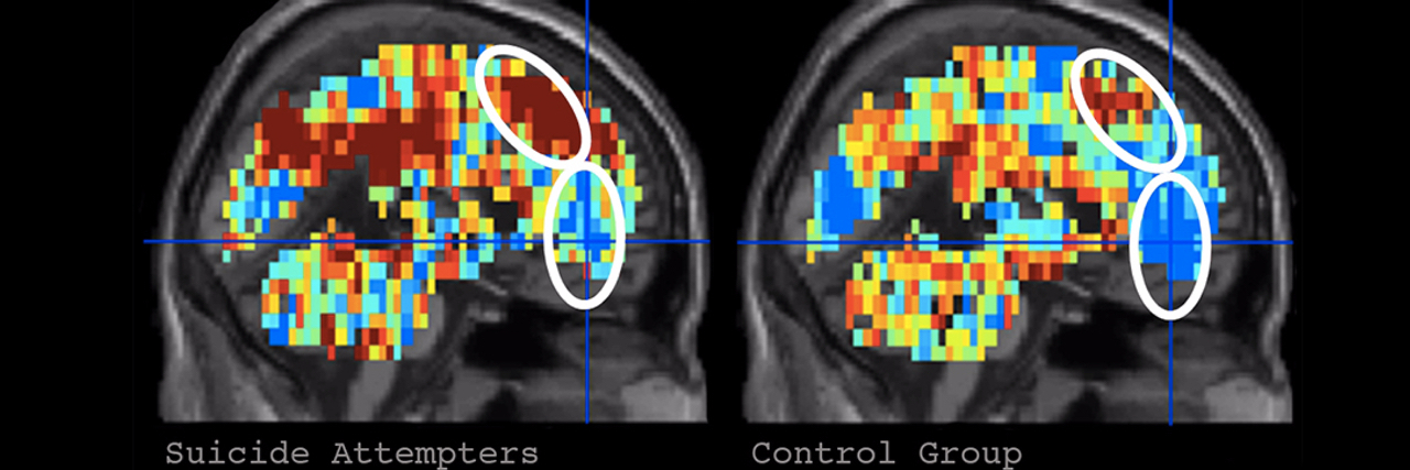 New Research Shows How Your Brain Is Different When You Are Suicidal Photo of two brain scans.