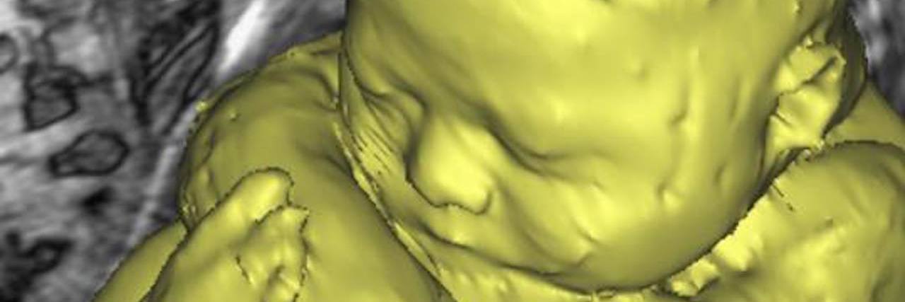 Doctor's Can't Predict the Future of a Baby Born With Down Syndrome