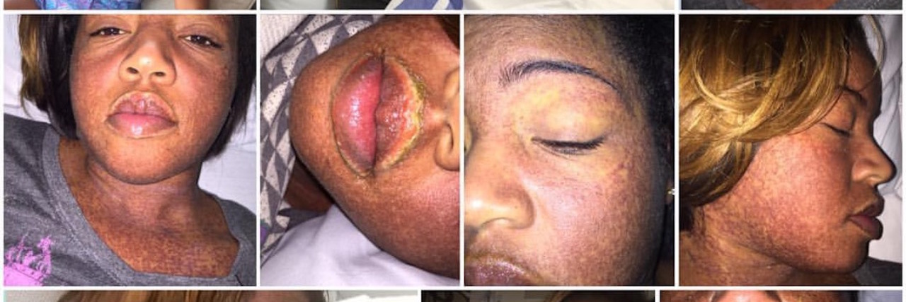 The Truth of Living With a Rare Disease Called DRESS Syndrome collage of photos of a woman in the hospital