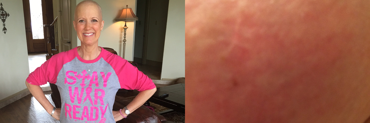 This Mom's Chest Rash Turned Out to Be a Rare Breast Cancer Jennifer Cordts feature