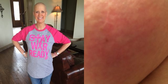 This Mom's Chest Rash Turned Out to Be a Rare Breast Cancer Jennifer Cordts feature