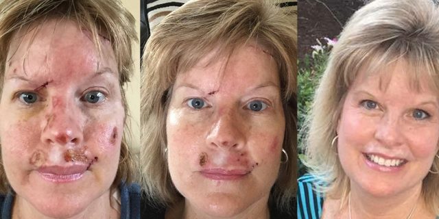 Judy Cloud skin cancer feature
