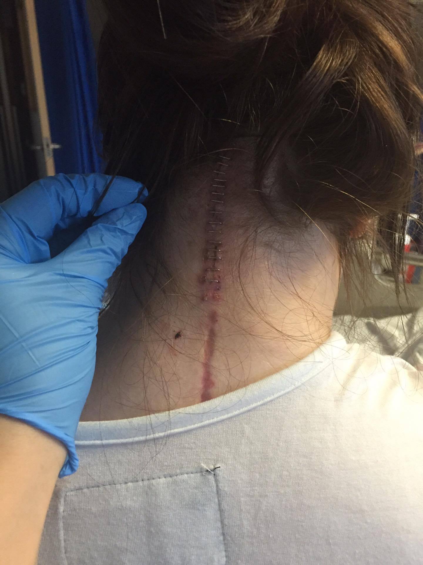 A picture of the back of the writer's neck with a surgical scar.