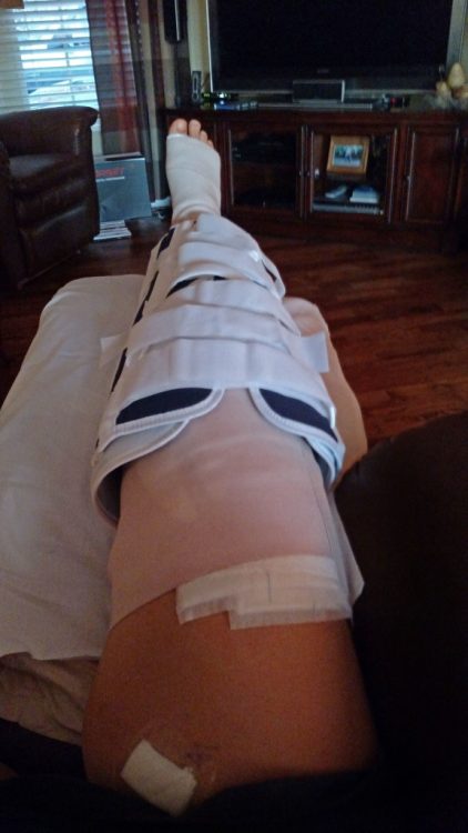 Debbie Spivey bandaged and braced leg