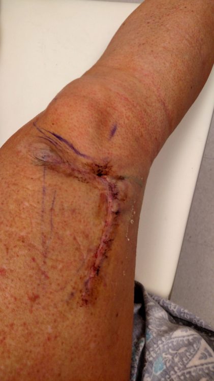 Debbie Spivey leg after surgery