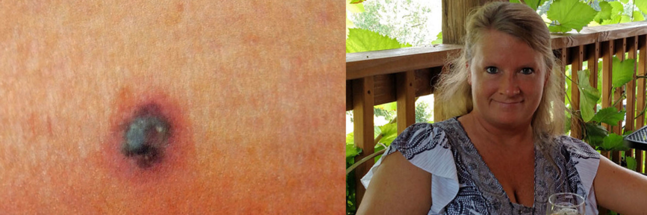 How a Cancerous Mole the Size of a Pea Turned My World Upside Down