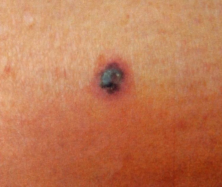 Debbie Spivey melanoma mole 1