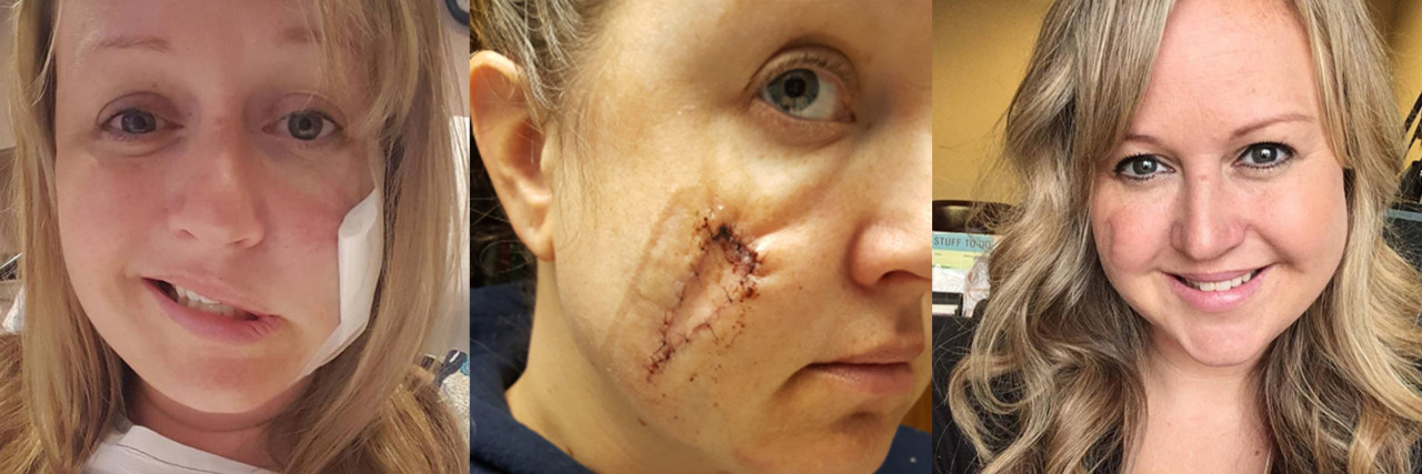 Genetics, Tanning Beds and Sunburns: My Melanoma Story Natalie Trout feature