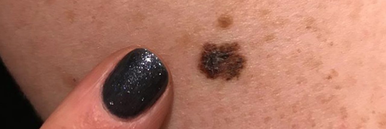 Stacey Waidley melanoma mole photo
