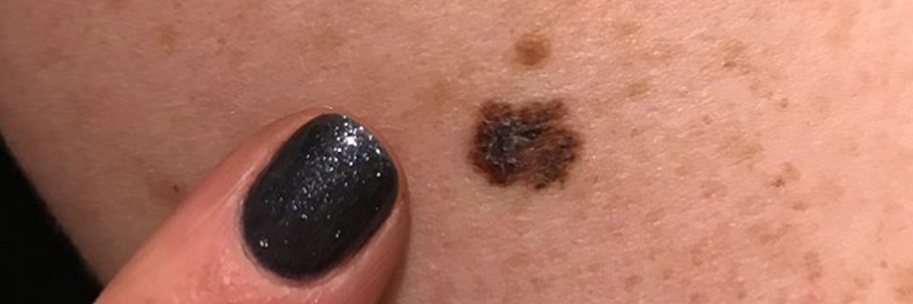 Esthetician Shares Photo of Client's Mole to Warn Against Skin Cancer Stacey Waidley melanoma mole photo