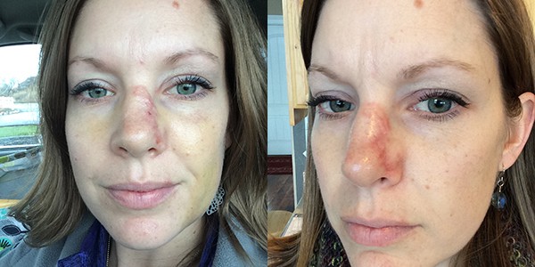 Mel Gunnell healing face few weeks