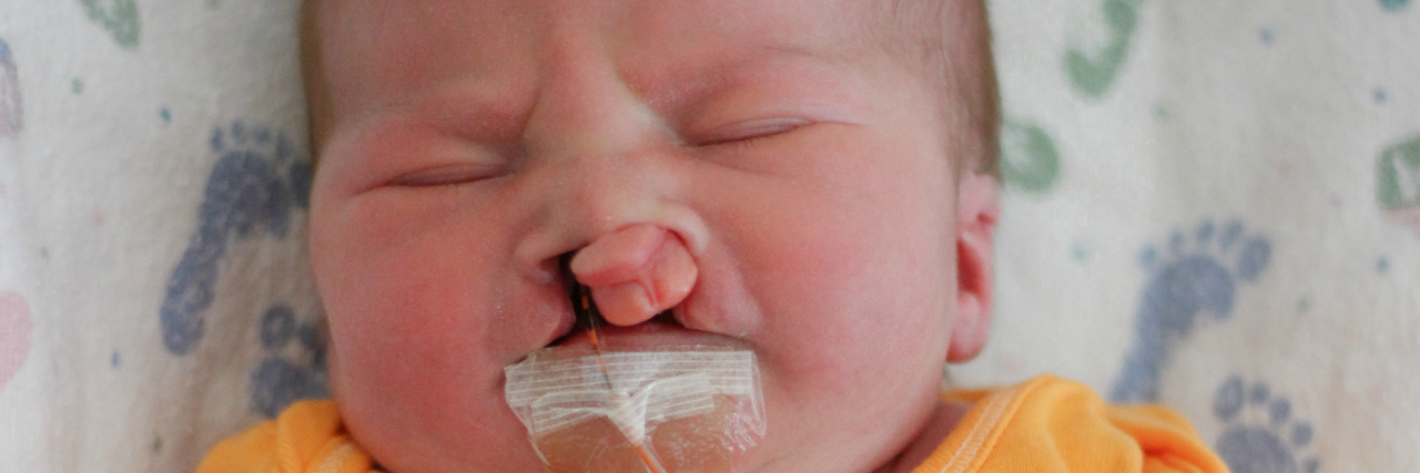 What Google Couldn't Tell Me About My Son's Condition baby boy with cleft lip