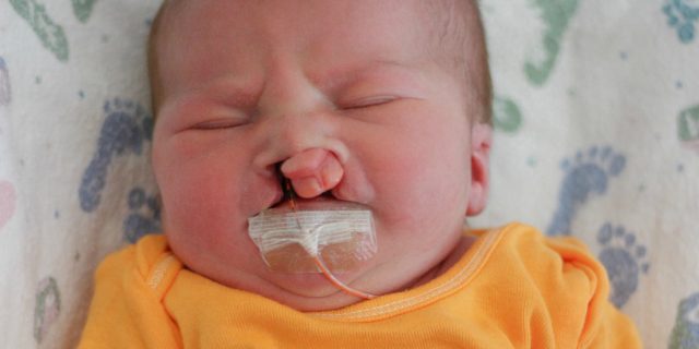baby boy with cleft lip