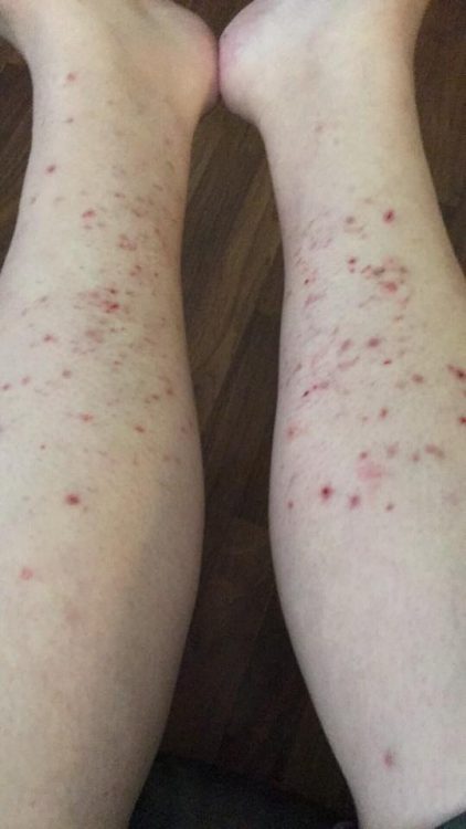 photo of a woman's legs covered in a rash of red bumps