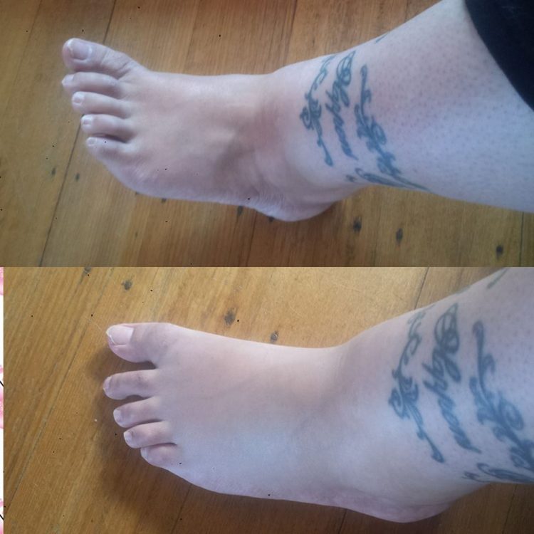 two photos comparing a woman's foot on a 'normal' day versus when it's very swollen