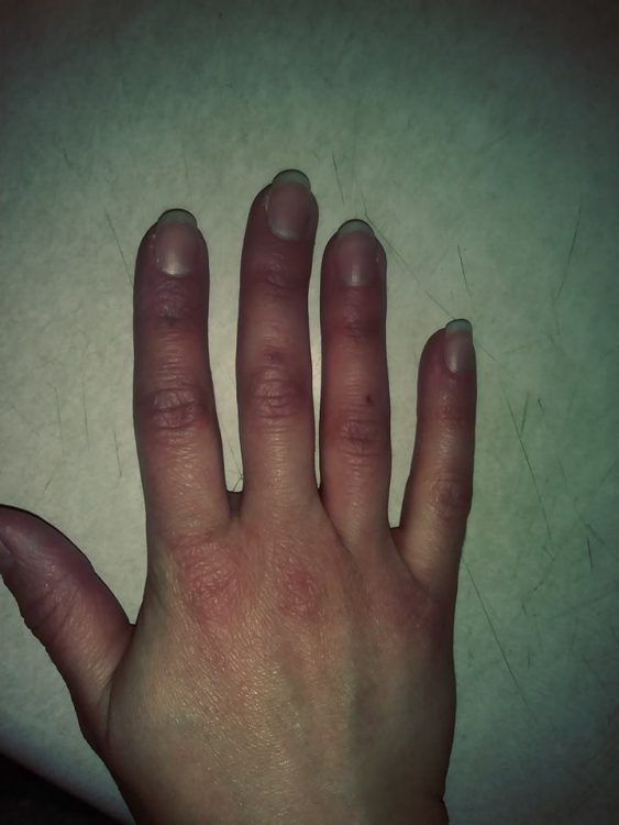 a woman's hand with her fingers looking red because of raynauds