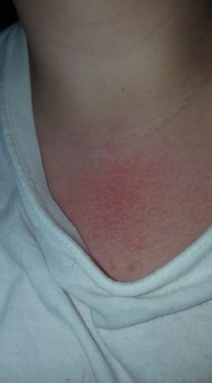 woman's chest looking red and splotchy from hives