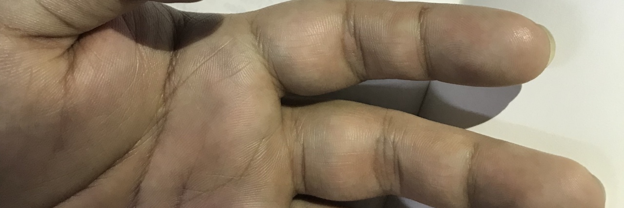 What My Partner's Hemophilia Taught Us About Pain man's hand next to drawing of the word 'ouchie'