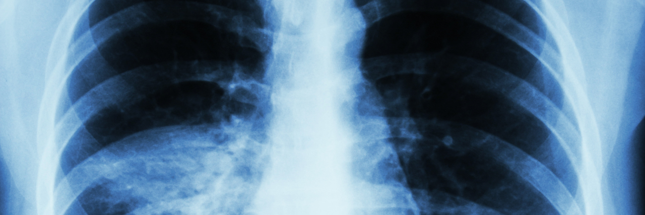 Letters to My Lungs chest x ray of lungs