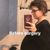 woman before having ovarian cyst removed