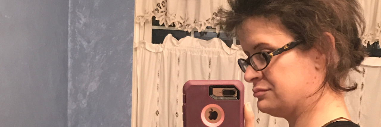 My Expanding Abdomen Was a 22-Pound Ovarian Cyst woman before having ovarian cyst removed