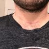 Ryan Buckley thyroid cancer neck