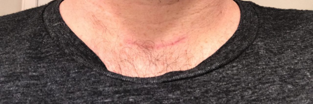 My Thyroid Got Cancer Ryan Buckley thyroid cancer neck