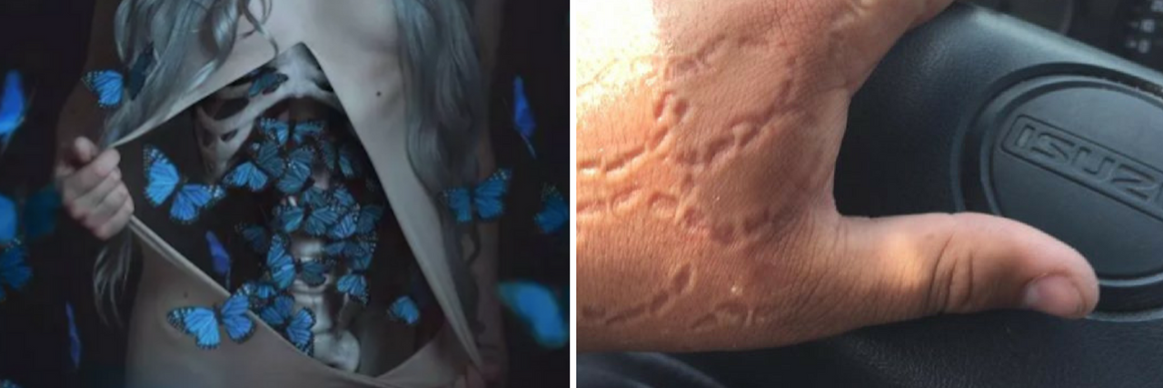 12 Pictures That Show the Different Ways Anxiety Manifests a picture of a woman with butterflies coming out of her stomach, next to a photo of a man with bite marks on his hand