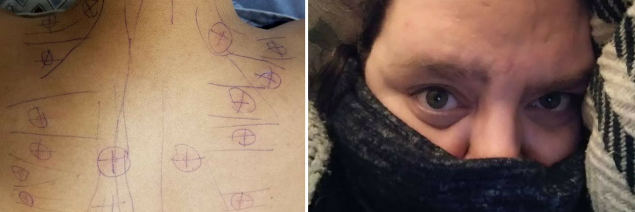 Photos of 13 Symptoms of Fibromyalgia woman with trigger points drawn on her back and woman with scarf wrapped around her face