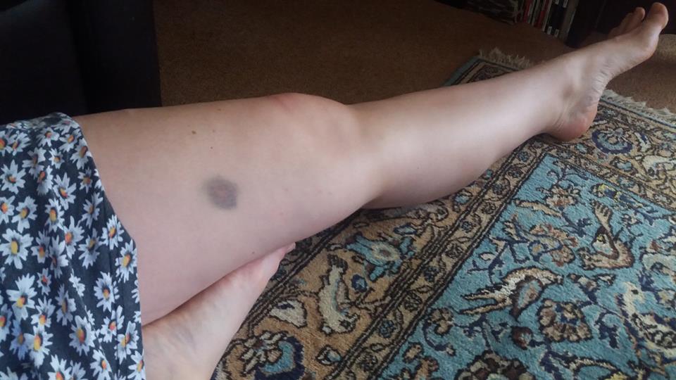 woman with a dark bruise on her leg