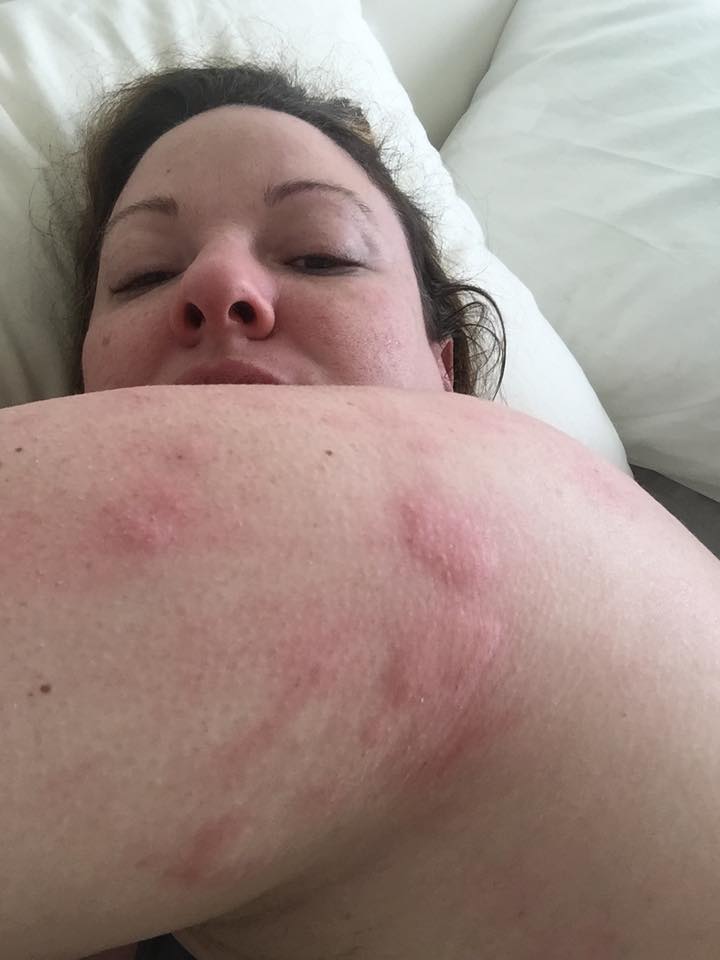 woman with hives on her arm