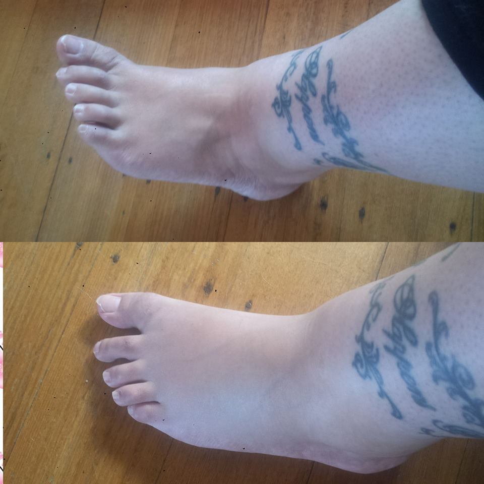 woman's swollen foot