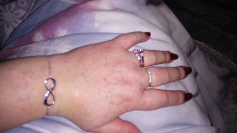 woman's hand looking swollen